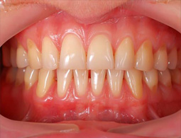 Close-up of gums and teeth