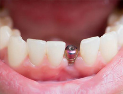 Single tooth Implant