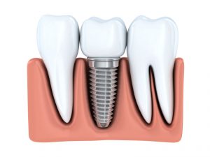 Learn why you should see a periodontist for your dental implants.