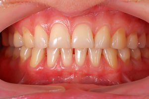 healthy gums