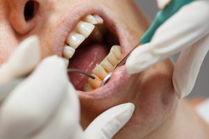 Patient receiving laser gum treatment