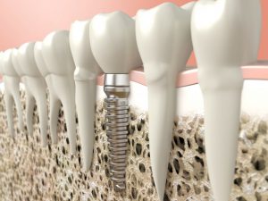 A diagram of dental implants.