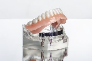 implant-supported dentures