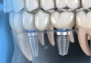 Dental implants in jaw